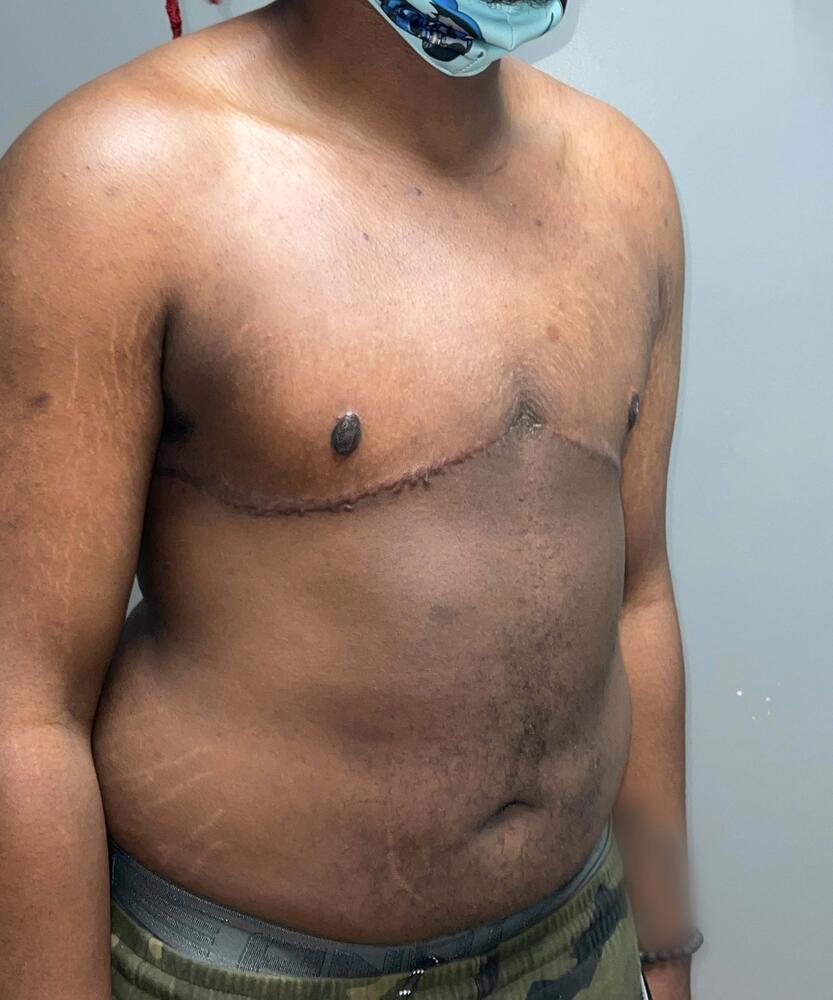 FTM Top Surgery Before & After Image