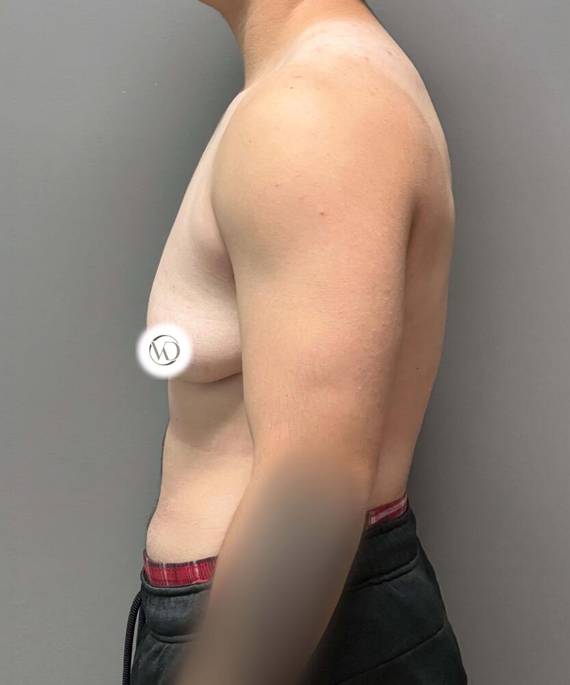 FTM Top Surgery Before & After Image