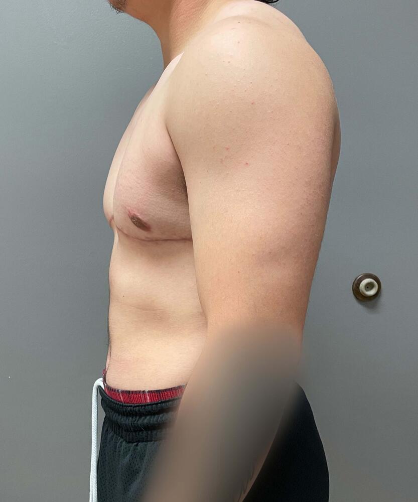 FTM Top Surgery Before & After Image