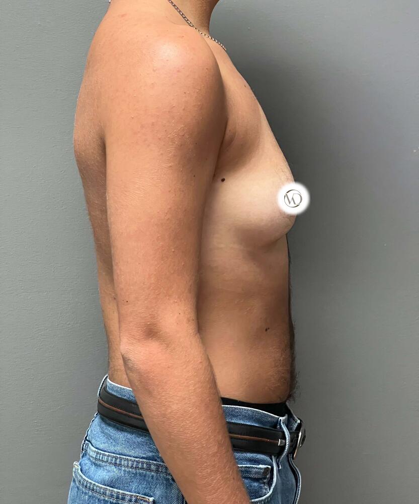 FTM Top Surgery Before & After Image