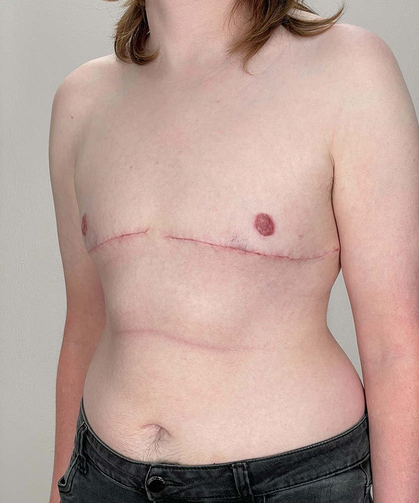FTM Top Surgery Before & After Image