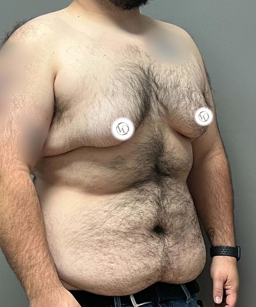 FTM Top Surgery Before & After Image