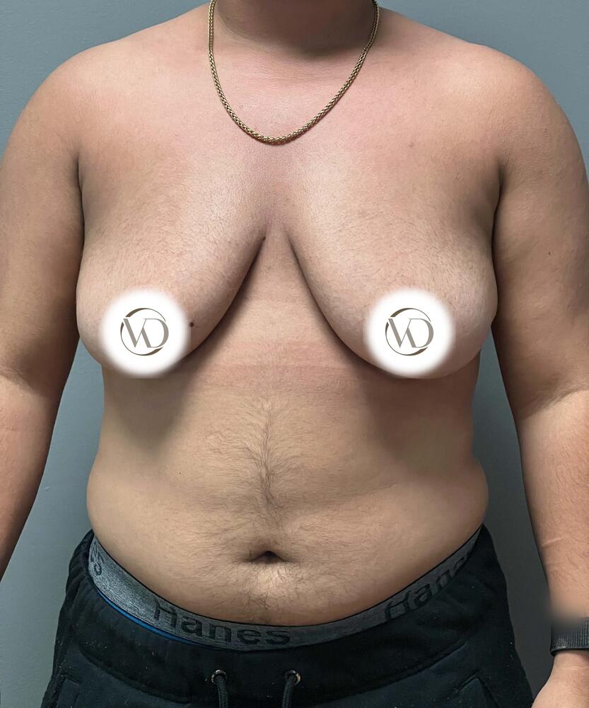 FTM Top Surgery Before & After Image