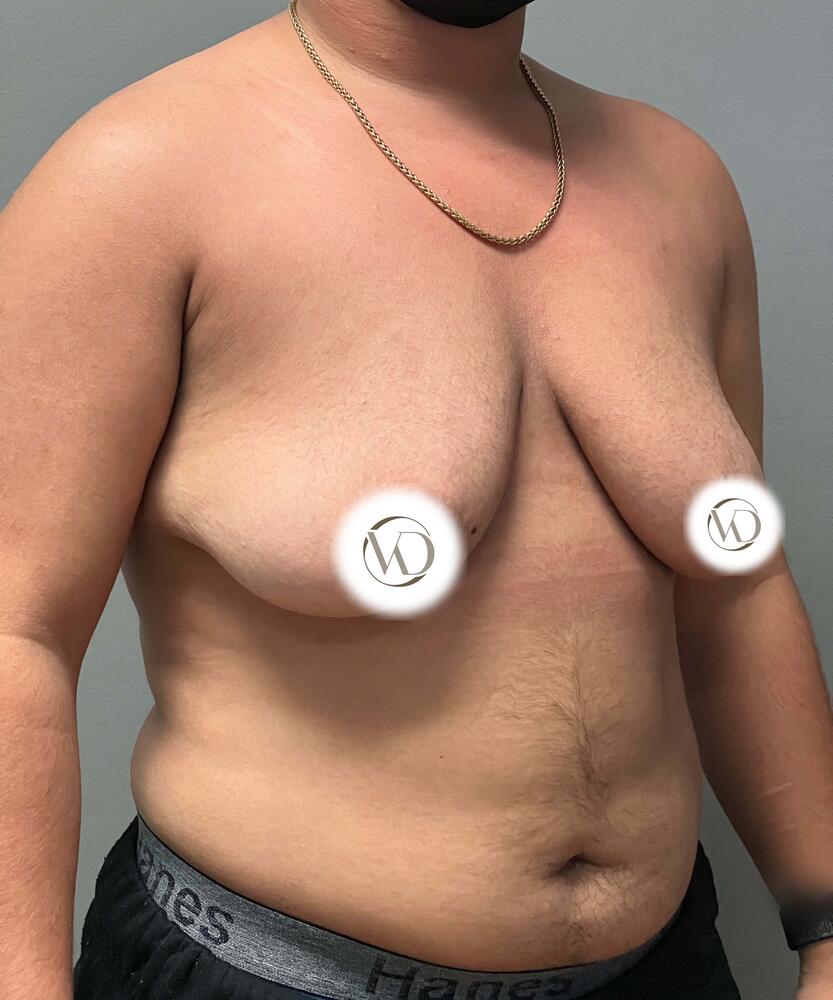 FTM Top Surgery Before & After Image
