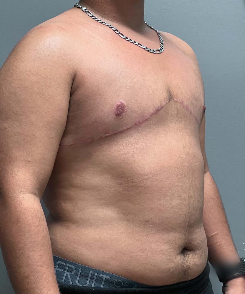FTM Top Surgery Before & After Image