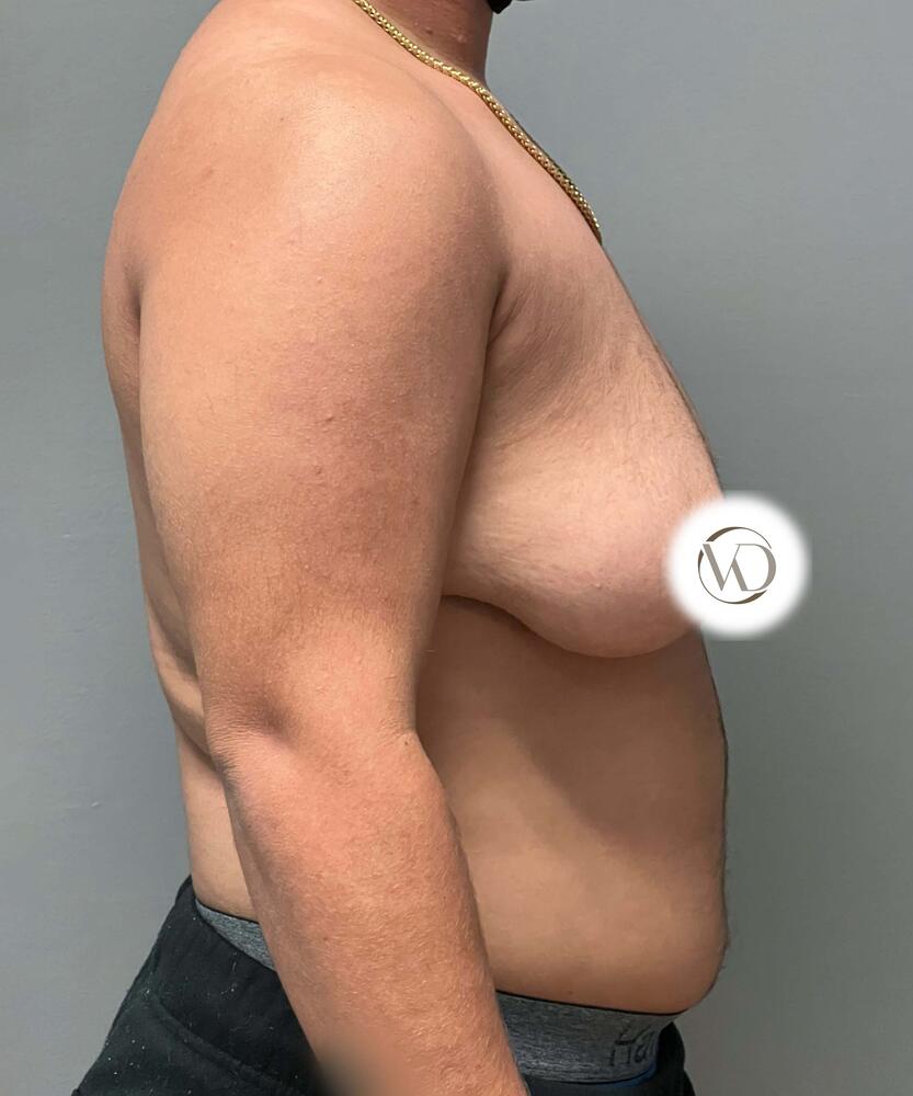 FTM Top Surgery Before & After Image