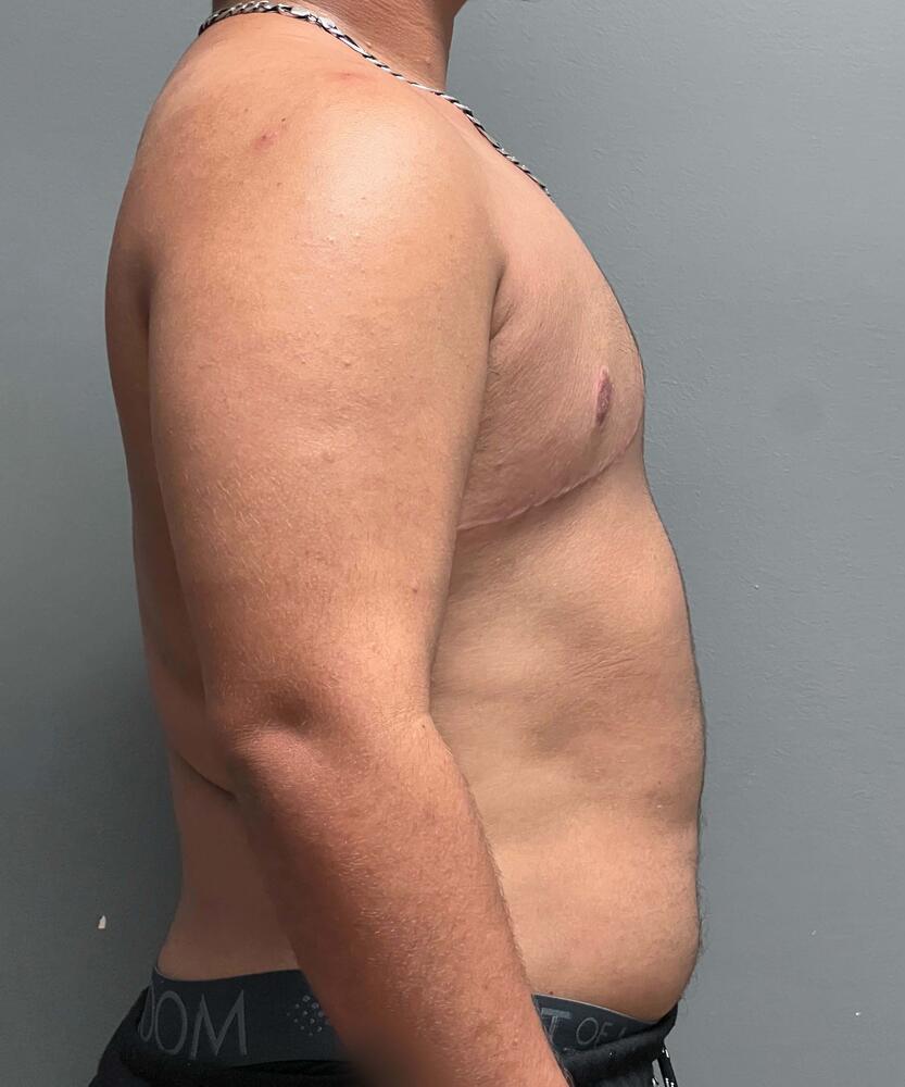 FTM Top Surgery Before & After Image