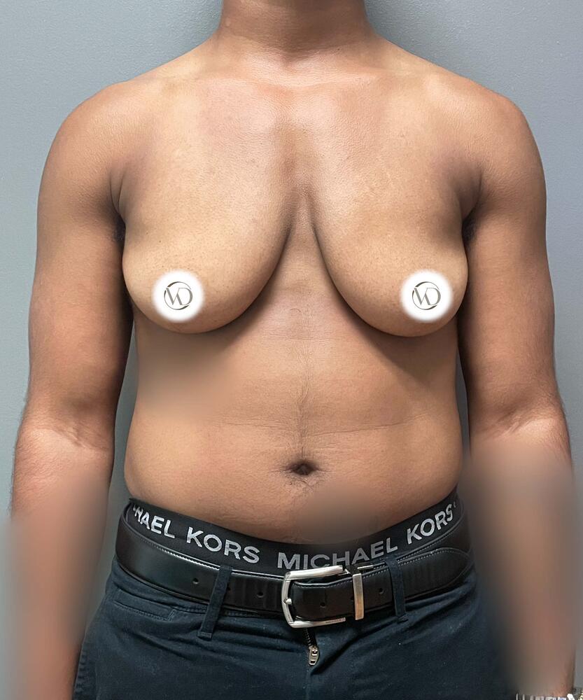 FTM Top Surgery Before & After Image
