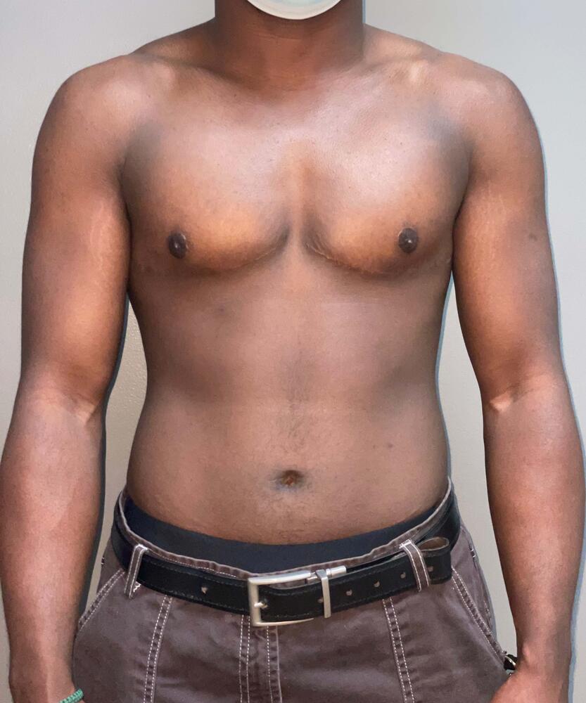 FTM Top Surgery Before & After Image