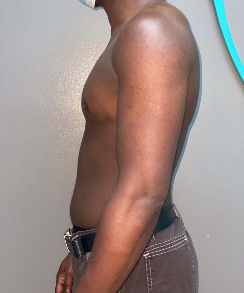 FTM Top Surgery Before & After Image