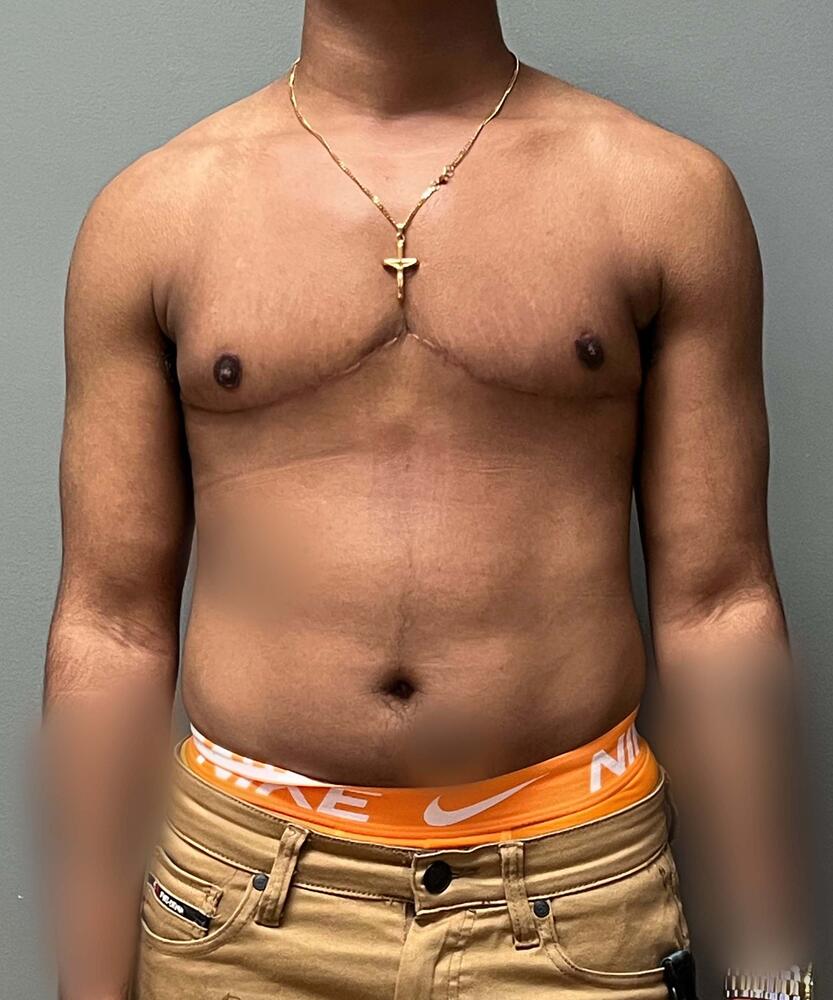 FTM Top Surgery Before & After Image