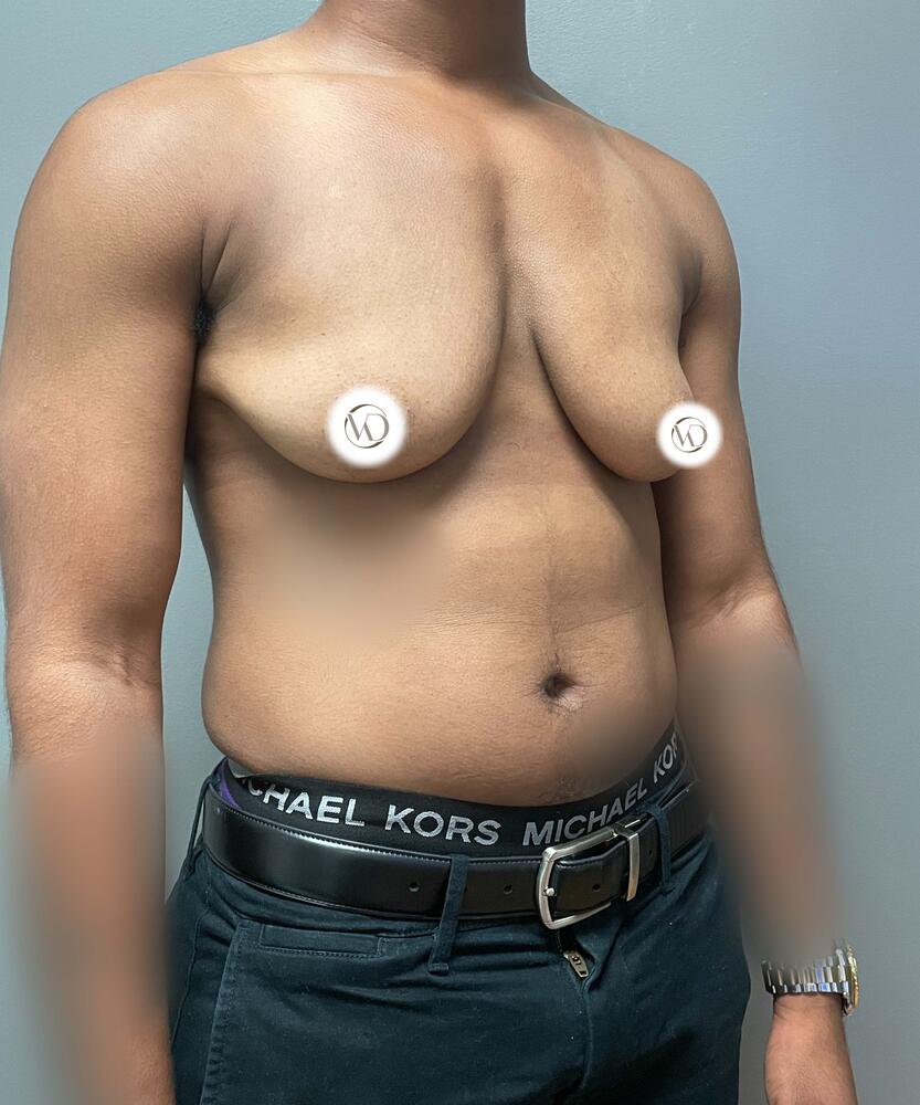 FTM Top Surgery Before & After Image