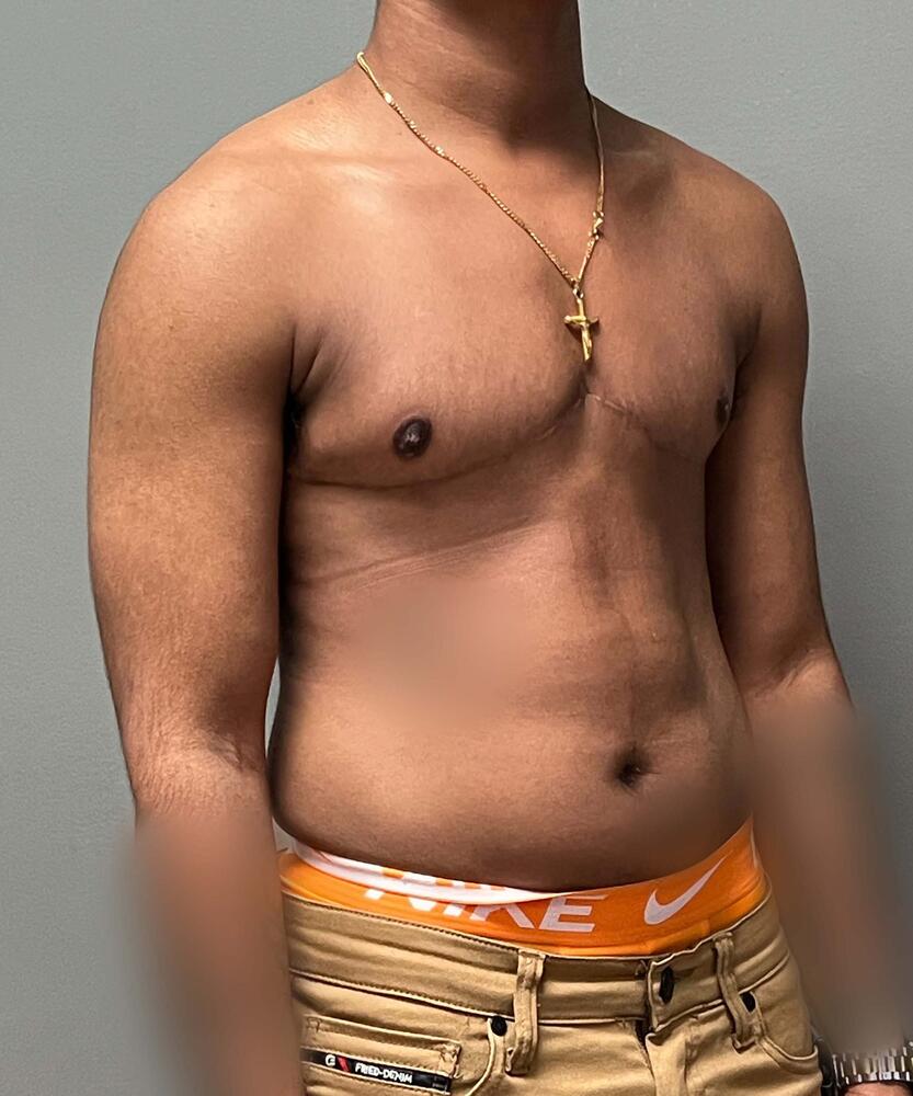 FTM Top Surgery Before & After Image