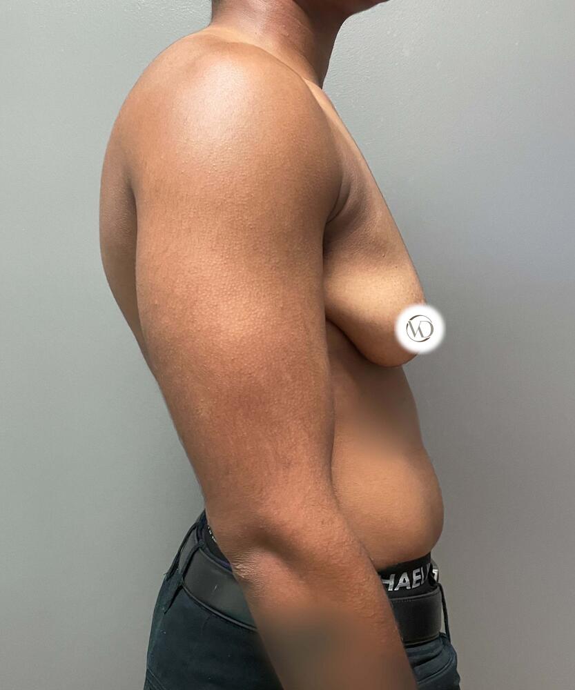 FTM Top Surgery Before & After Image