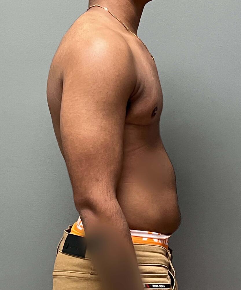 FTM Top Surgery Before & After Image