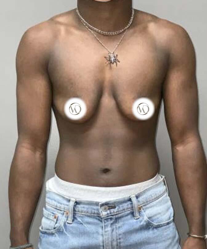 FTM Top Surgery Before & After Image