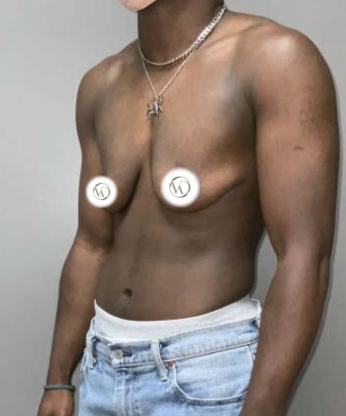 FTM Top Surgery Before & After Image