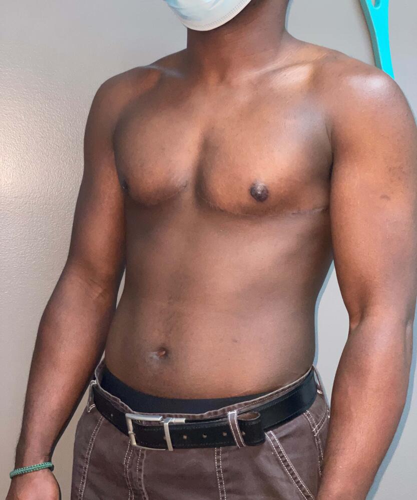 FTM Top Surgery Before & After Image