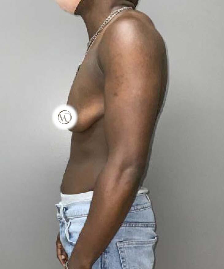 FTM Top Surgery Before & After Image