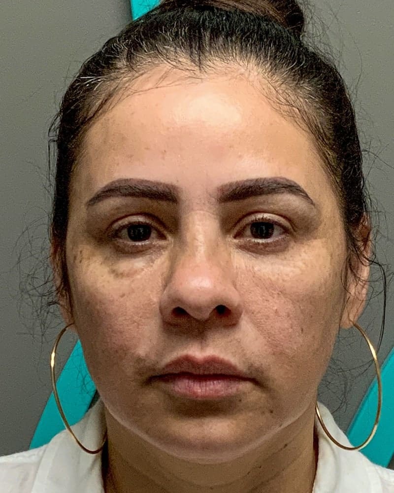 Sculptra Before & After Image
