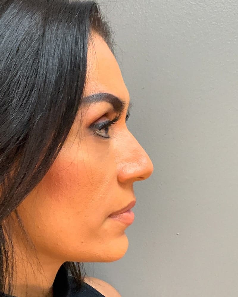 Blepharoplasty Before & After Image