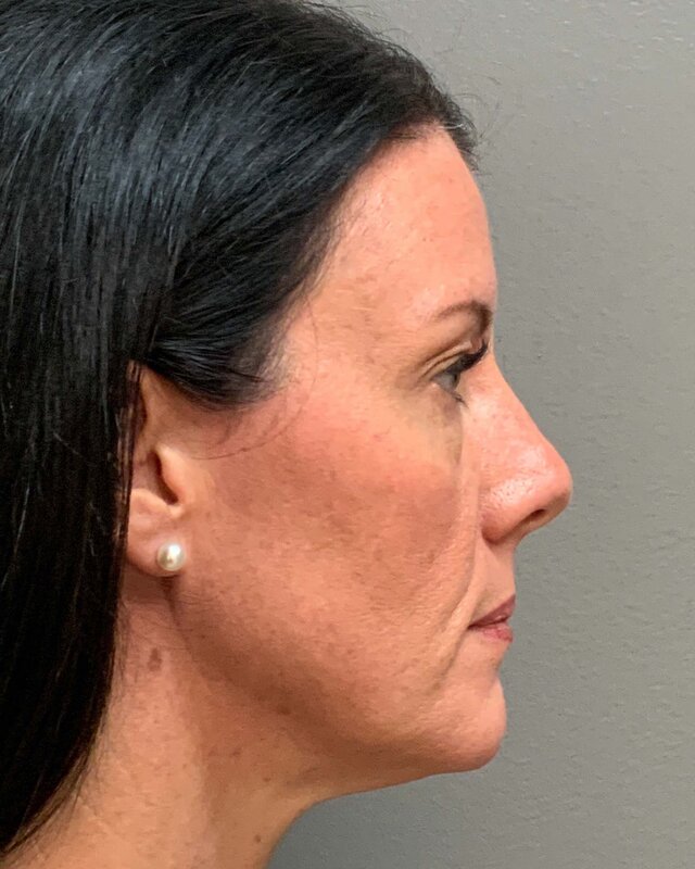 Blepharoplasty Before & After Image