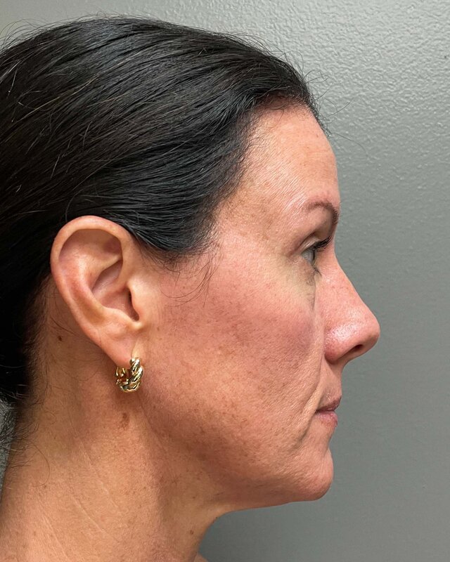 Blepharoplasty Before & After Image