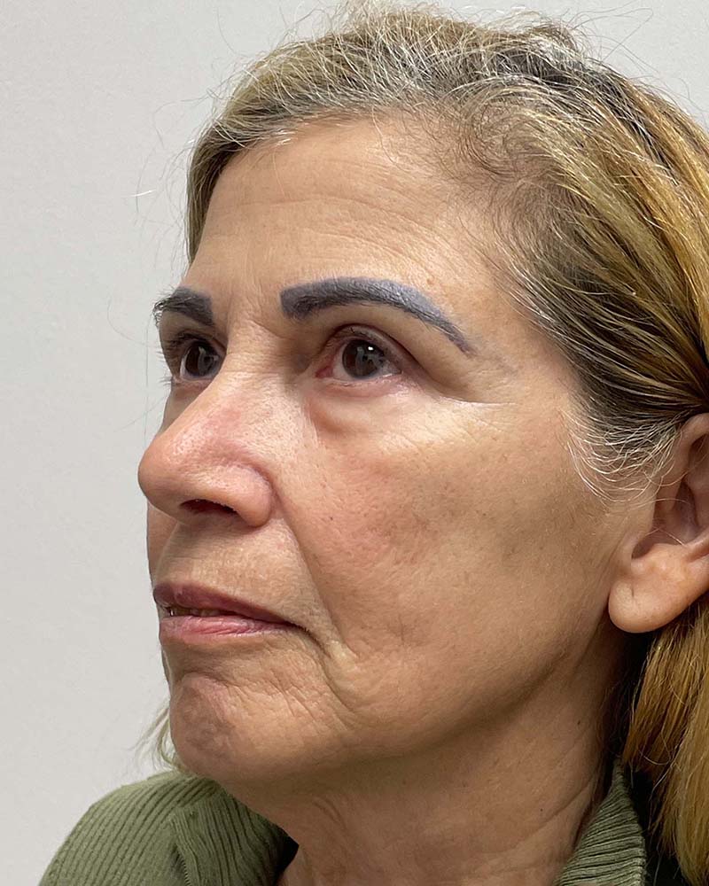 Blepharoplasty Before & After Image