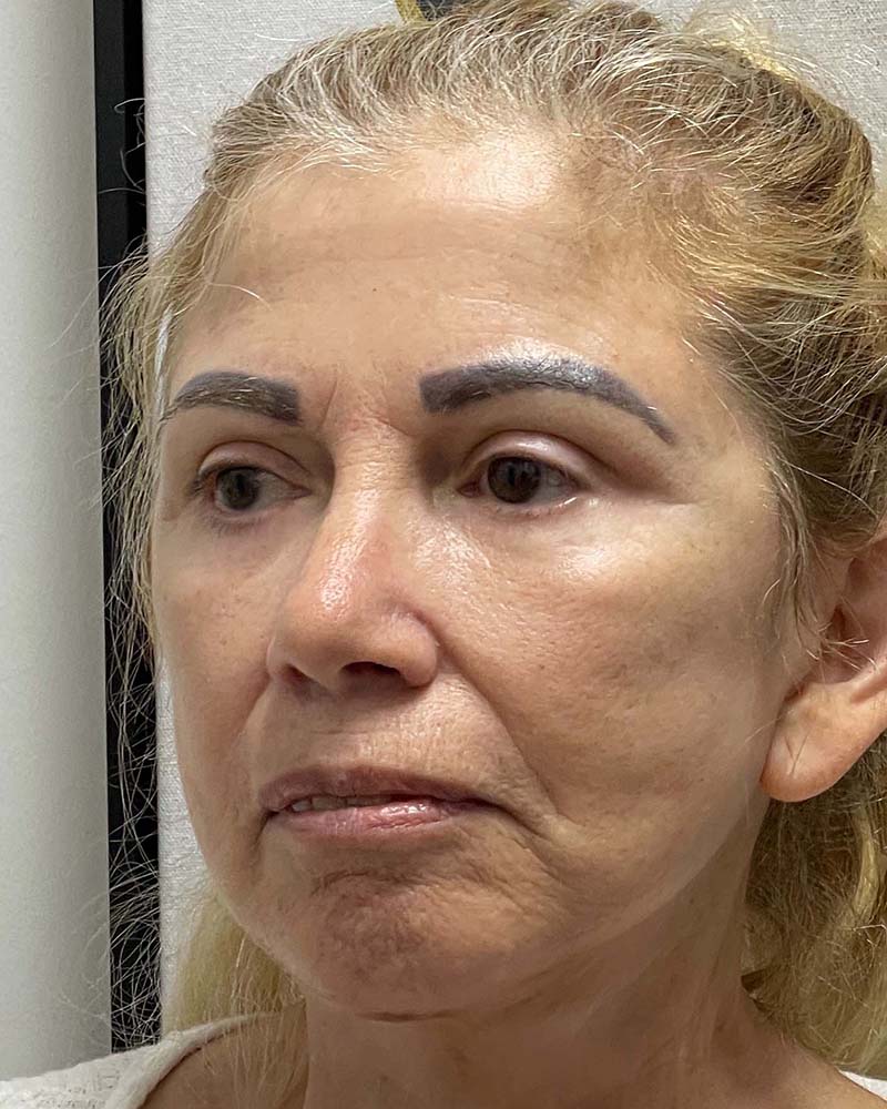 Blepharoplasty Before & After Image