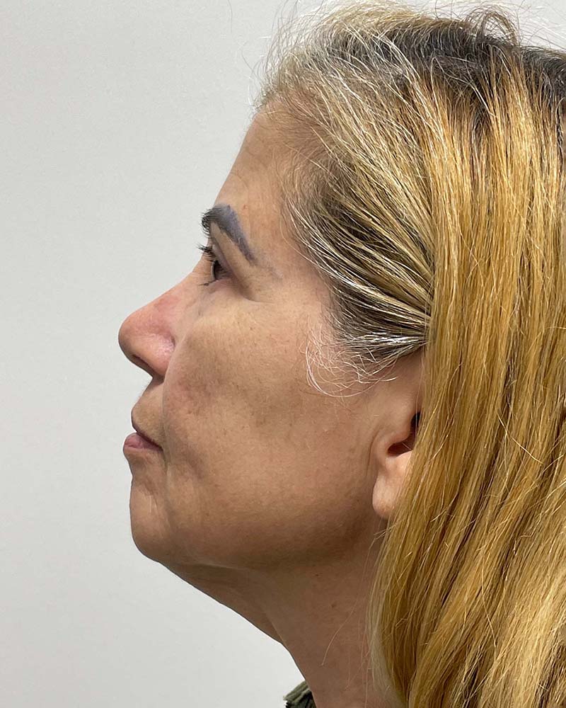 Blepharoplasty Before & After Image