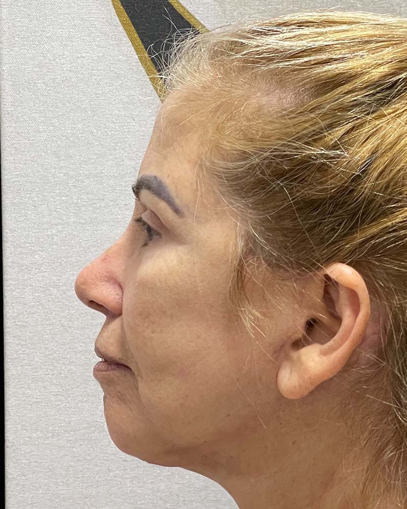 Blepharoplasty Before & After Image