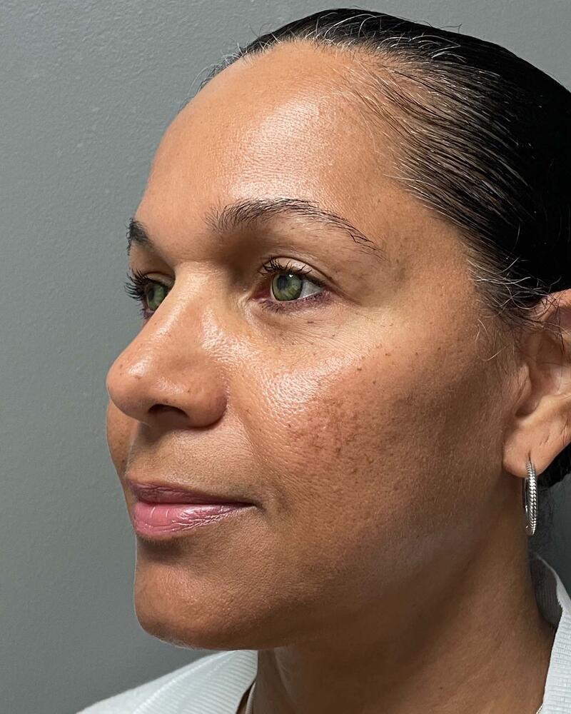 Blepharoplasty Before & After Image