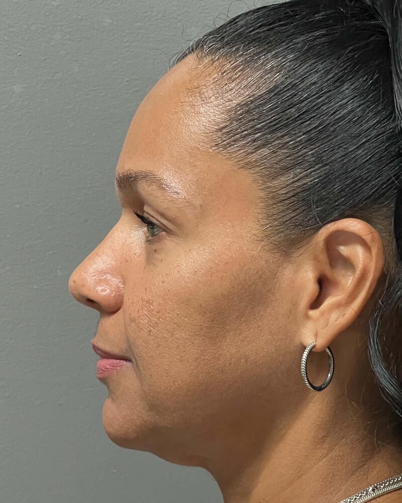 Blepharoplasty Before & After Image