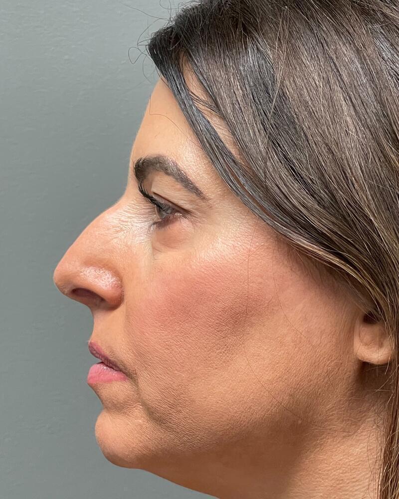 Blepharoplasty Before & After Image