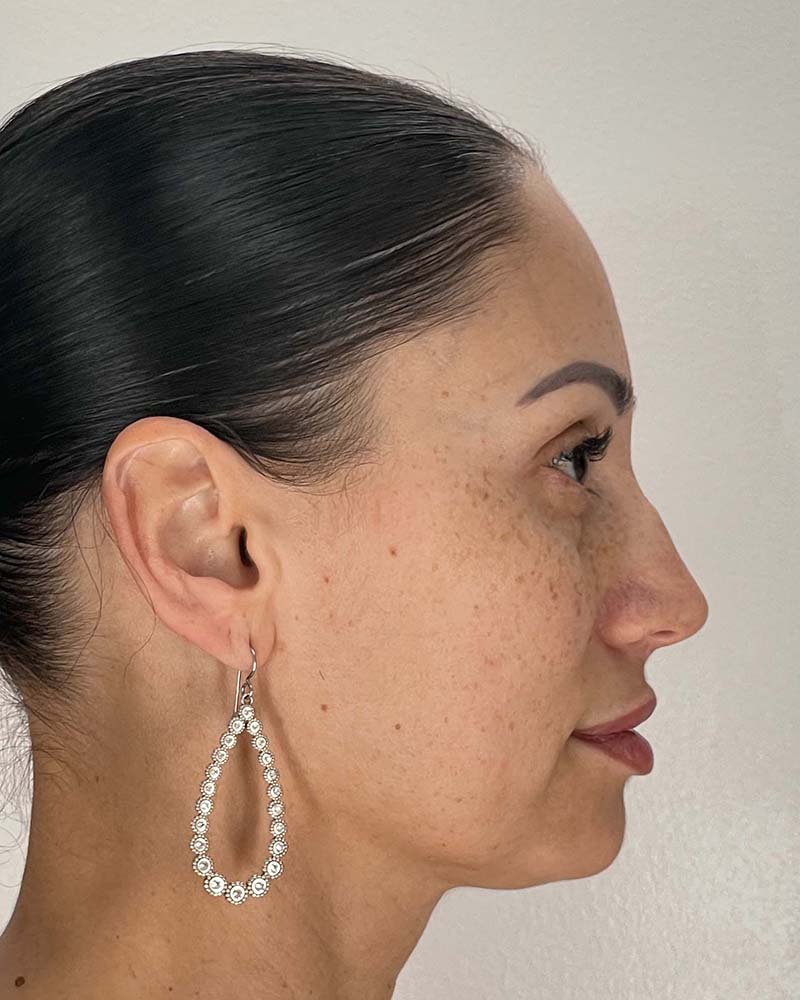 Blepharoplasty Before & After Image