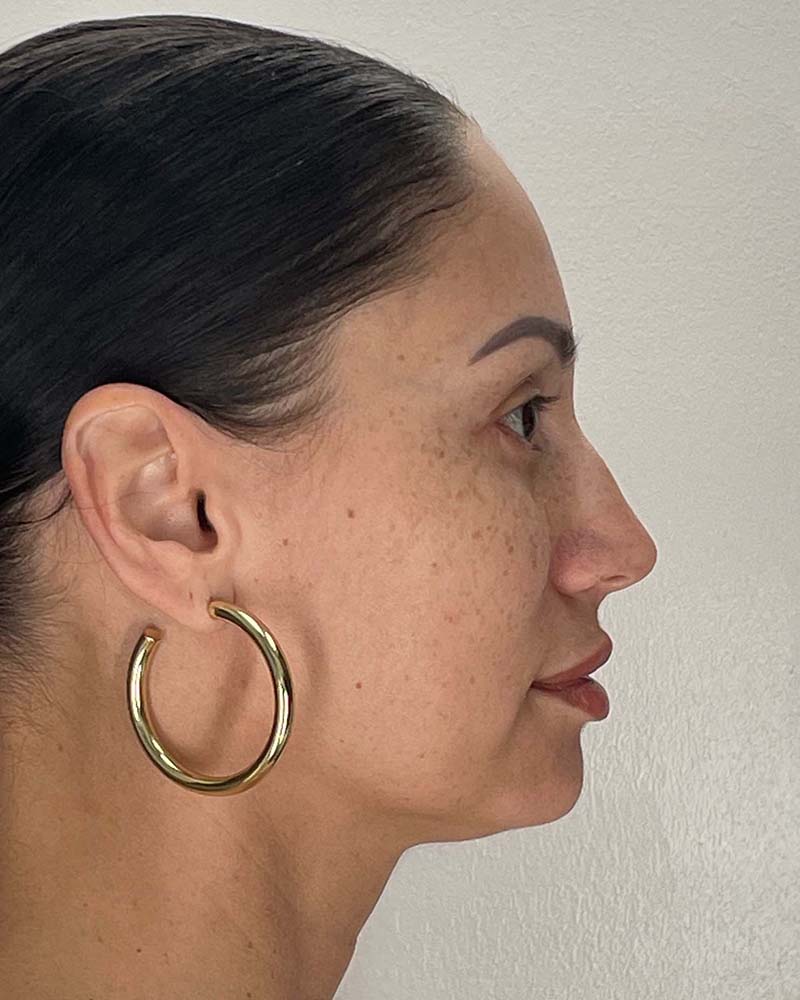 Blepharoplasty Before & After Image