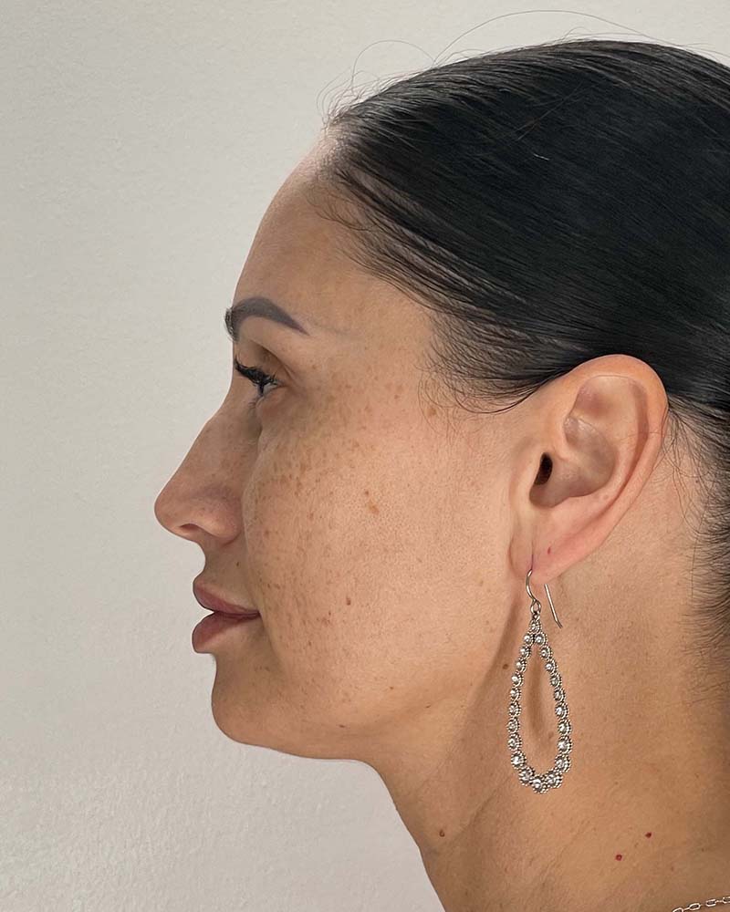 Blepharoplasty Before & After Image