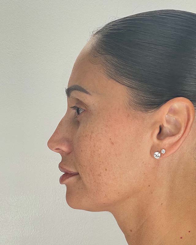 Blepharoplasty Before & After Image