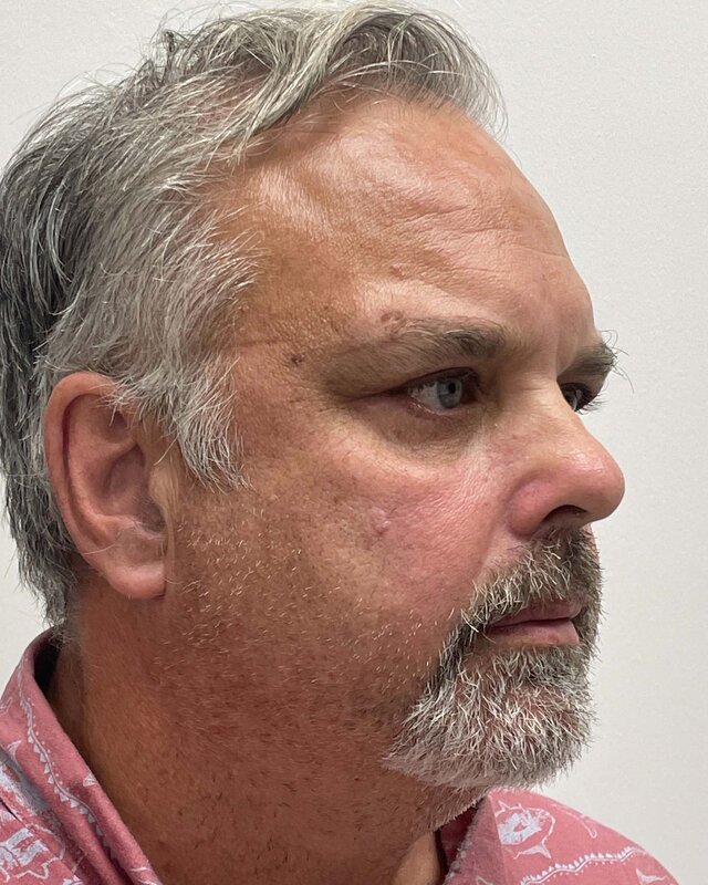 Blepharoplasty Before & After Image