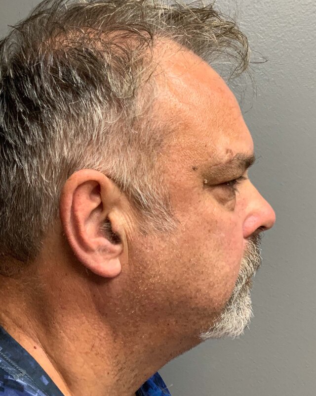 Blepharoplasty Before & After Image