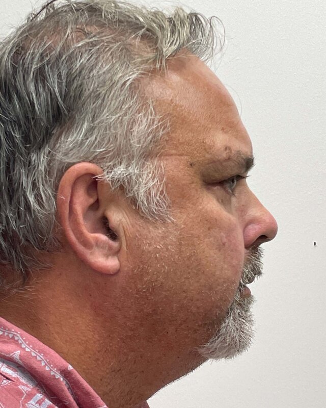 Blepharoplasty Before & After Image