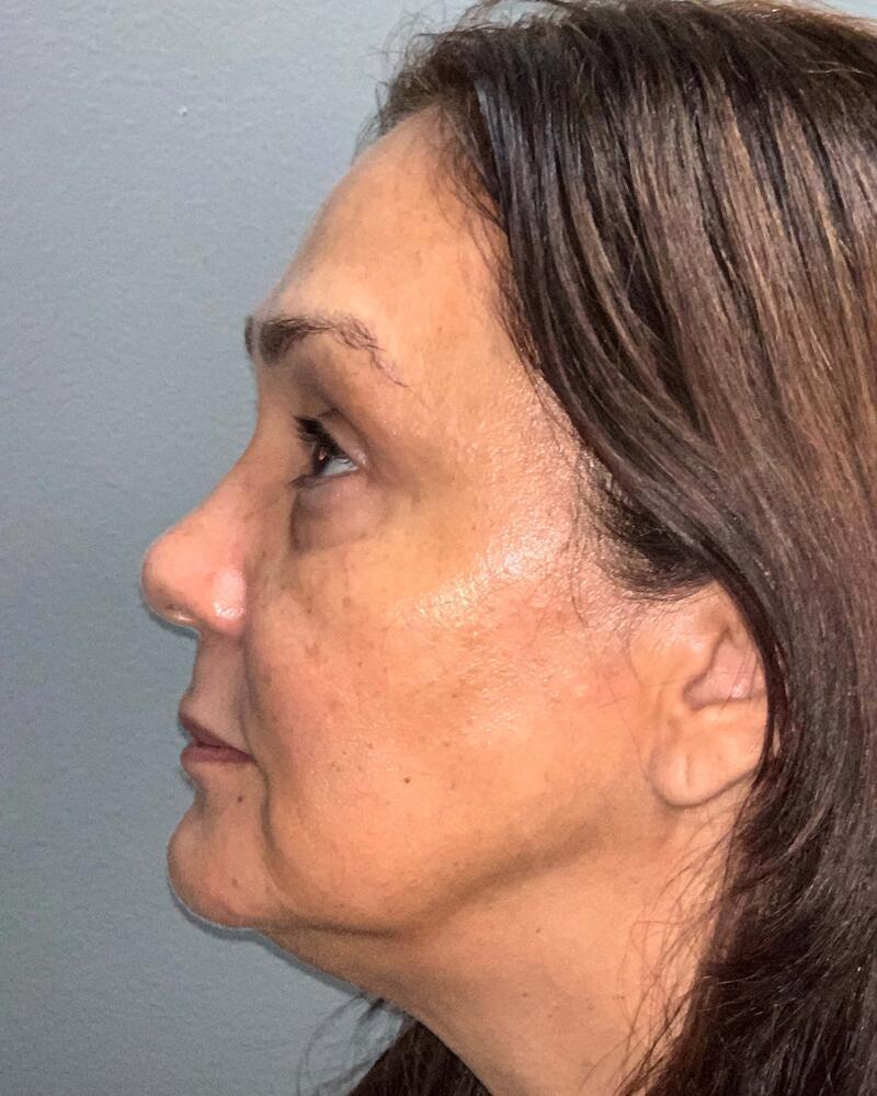 Blepharoplasty Before & After Image