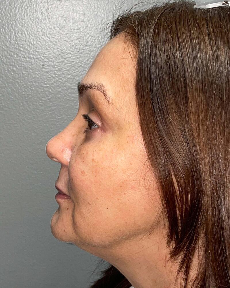 Blepharoplasty Before & After Image