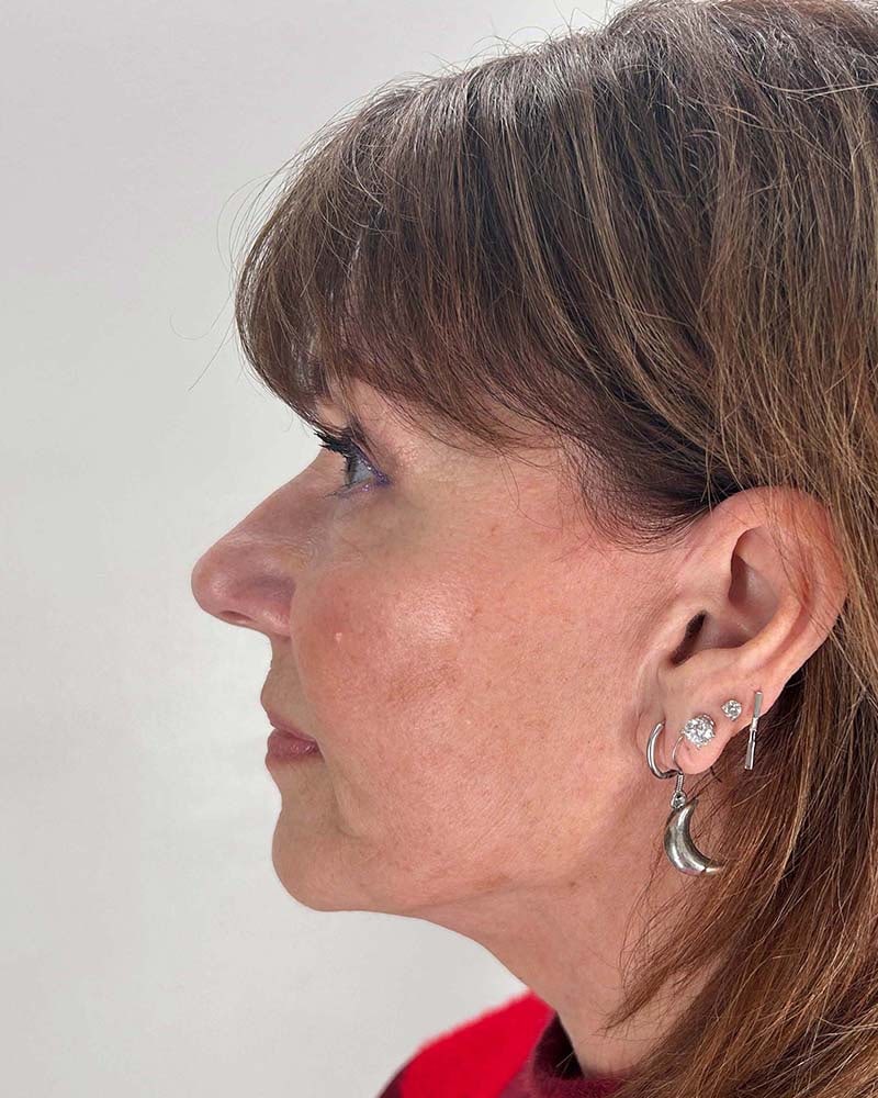 Blepharoplasty Before & After Image