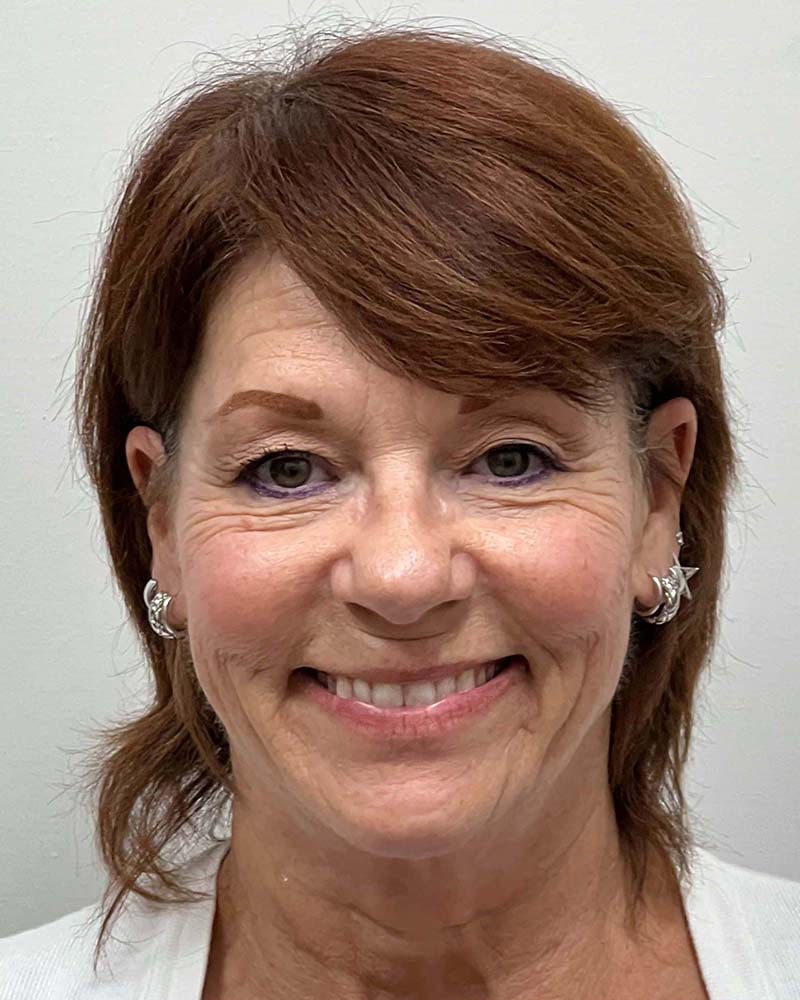 Blepharoplasty Before & After Image