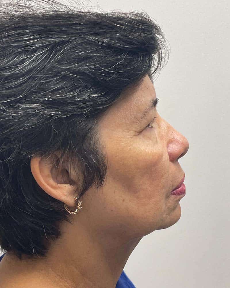 Blepharoplasty Before & After Image