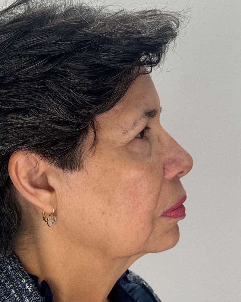 Blepharoplasty Before & After Image