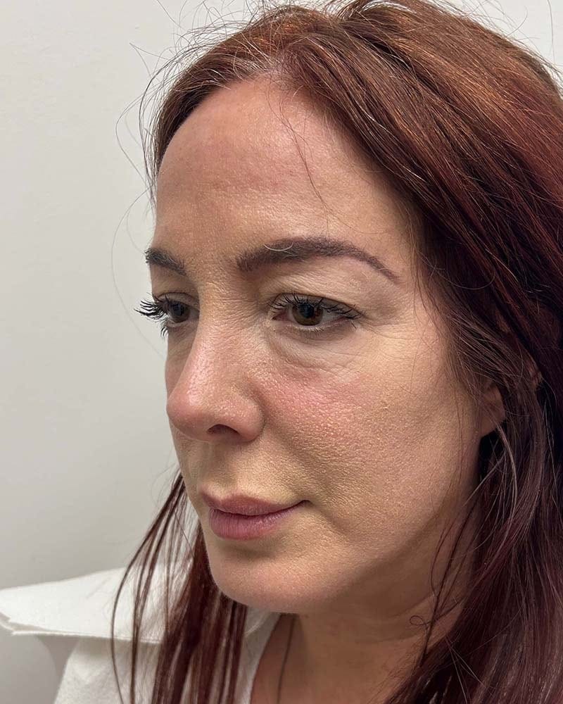 Blepharoplasty Before & After Image