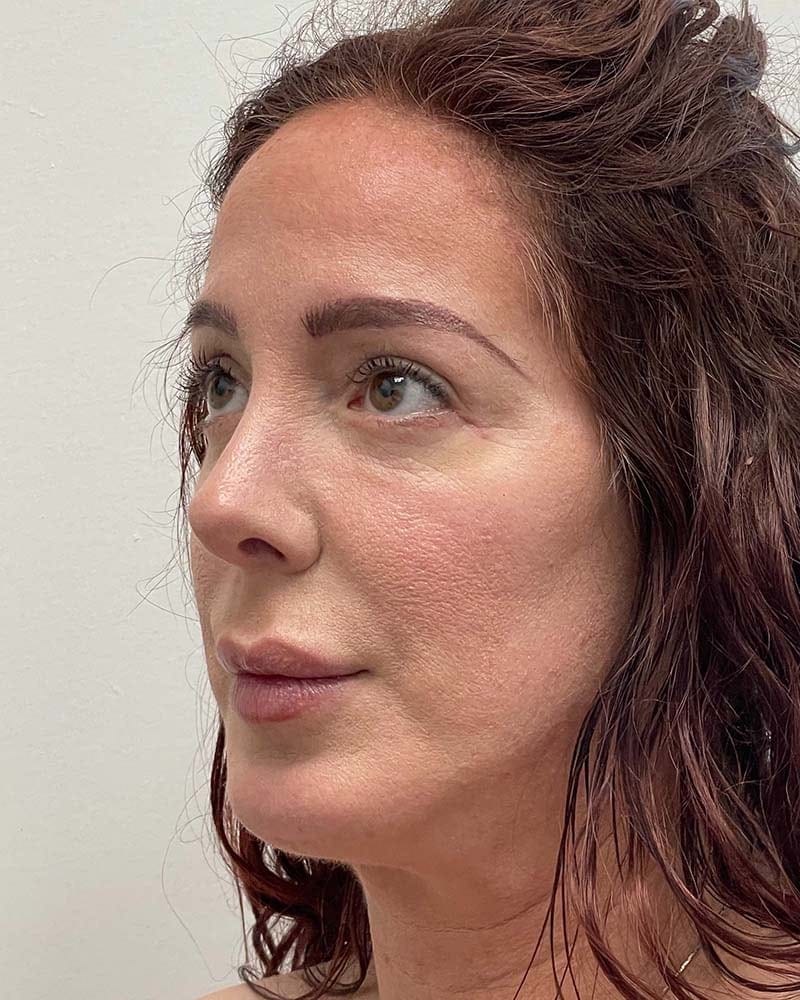 Blepharoplasty Before & After Image