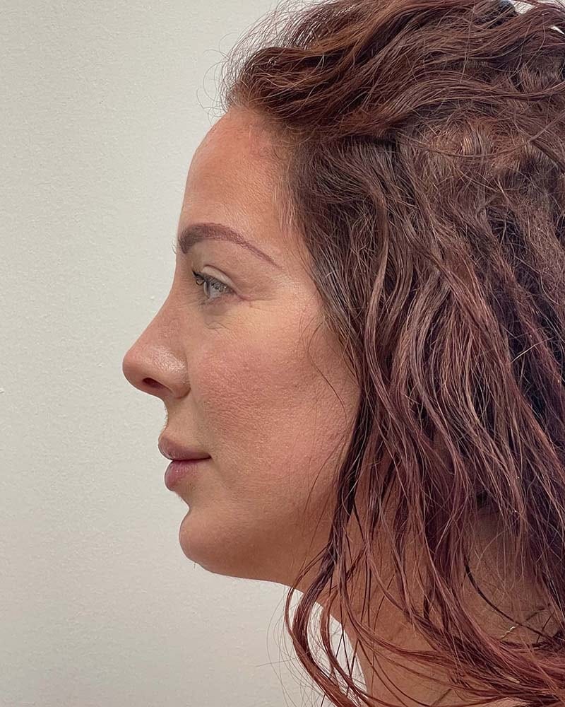 Blepharoplasty Before & After Image